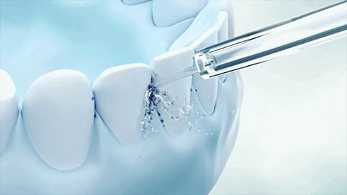 Benefits of Water Flossers for Braces Wearers